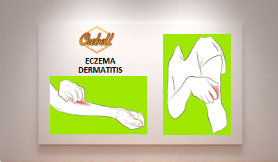 S3-A-Eczemas-Dermatitis